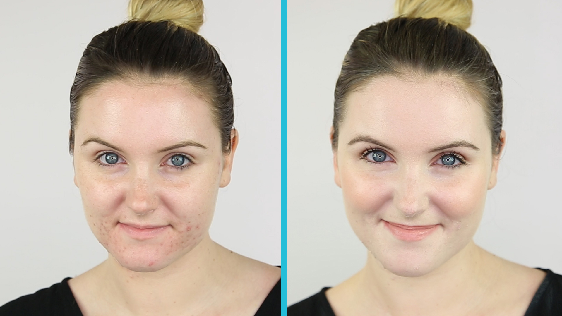 Flawless foundation routine for acne coverage