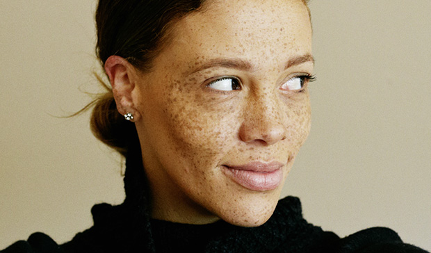 What is melasma and how can it be treated?