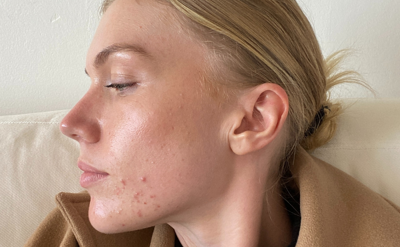 I Went To See A Dermatologist About My Hormonal Acne And This Is What Happened